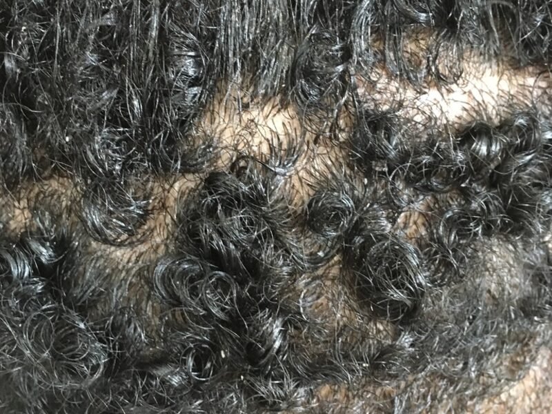 Scalp therapy treatment